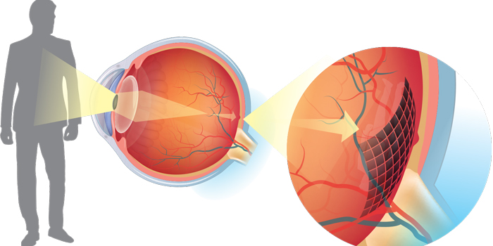Solceller implanteret på øjets nethinde kan erstatte en lille del af de fotoreceptorer, der ikke fungerer. Solcellerne påvirkes af lyset, der trænger ind i øjet, producerer strøm og sender impulser til synsnerven.