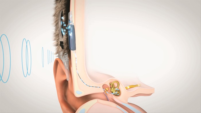 Cochlear Implant