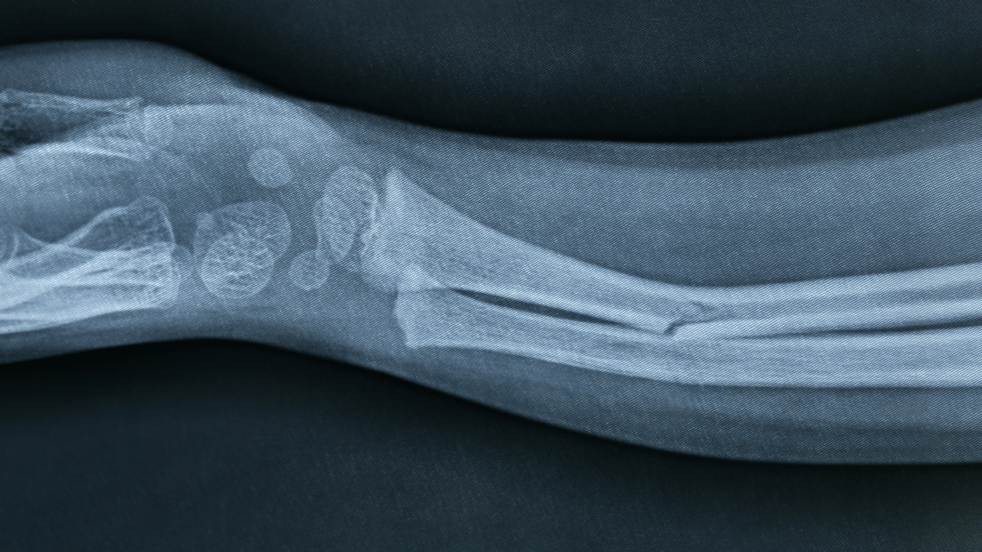 Røntgenbillede af en brækket arm. Foto: Colourbox