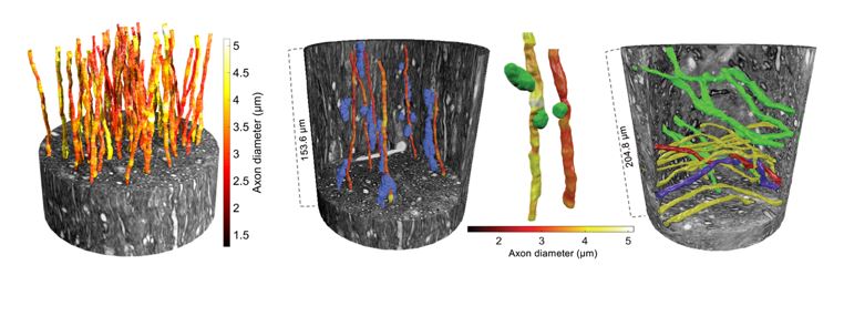 The picture: On left: Large axons of varying diameter (see colour bar) within an x-ray nano-holotomography volume of the white matter from a brain.   Second from left: the paths of the axons are affected by the positions of cell clusters (in blue).   Third from left: vacuoles (green) could also be found in the tissue and affected the diameter of axons. Right: Large crossing axons, travelling in different directions (represented by the green/yellow colours), in another region of the white matter. The large field-of-view accessible via the synchrotron imaging experiments allows for the tracking of two axons that twist around each other (in red and blue).